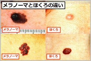 mole-melanoma